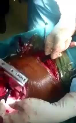 Big Cleaver removed from chest
