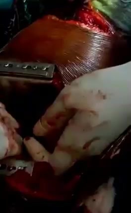 Big Cleaver removed from chest