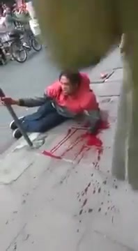 Brazilian thief with hand chopped off by machete