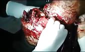 Amputation of a badly fractured leg