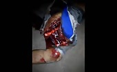 Guy got his leg amputated and arm chopped