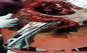 Lady Impaled With Big Metal Scrap Through Her Head