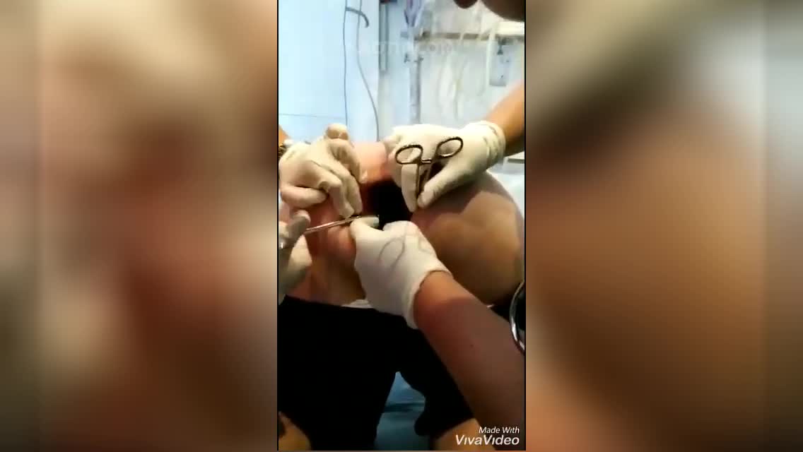 anal plug removal Anal plug removal gone wrong