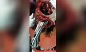 A piece of iron punctured via the skull