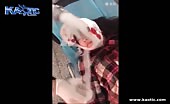 Girls Scalp Is Ripped Off Her Skull