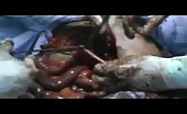 Graphic - surgery for an injured in his stomach 