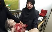 Syria, Small Girl Terribly Injured In Bomb Blast