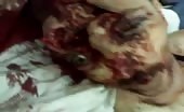 Victim of Syria Hama city bombing