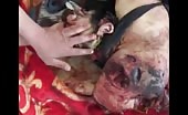Syrian Civilian Completely Mangled 