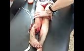 Child With Severe Injured Leg (Graphic Content)