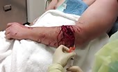 Forearm LAC due to Chainsaw accident
