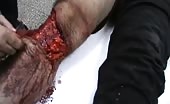 Nasty Wounded Leg Injury