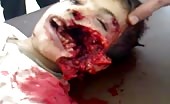 Child With Blasted Face (Graphic Content)