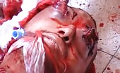 Nasty Head Injury, Eyes Popped Out
