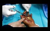 Amputation Of The Left Finger