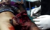 Young Kid With Face Wound And Thigh Destroyed