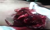 Man With Arm Ripped Off And Heart Beating