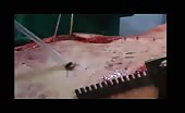 Operation Of An Open Chest Wound