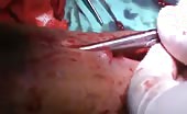 Removal Of A Metal Plate From The Leg