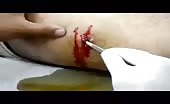 Retrieving Metal Object From Injured Leg