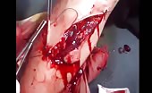 Suture Process Of Brutally  Wounded Leg