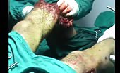 Men With Multiple Leg Injuries 