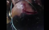 Stitching The Deep Big Cut In Forehead
