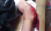 Man With Ripped Elbow Skin