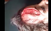 Nasty wound on Forehead