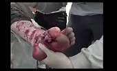 Sewing Of Ripped Foot