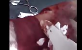 Metal Fragment Extraction From Wrist
