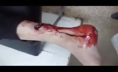 Man Gets Deep Cut By Shrapnel Hit