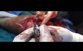 Orthopedic Surgery Of A Wounded Leg