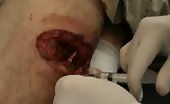 Man Suffering From Shrapnel Wound