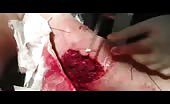 Treatment of Big Wound In Arm