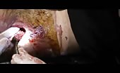 Extracting A Metal Fragment From Wound