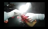 Severely damaged hand amputation in process