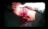 Nasty injuries in the foot