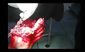 Crushed foot surgery