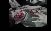 Children Wounded By Assad Gang (Graphic Content)