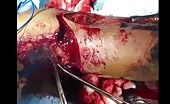 Amputation Of Injured Leg