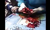 Amputating A Damaged Hand