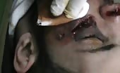 Nasty Cut Injury Under The Eye