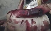 Severely Injured By Brutal Bombing