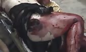 Brutally Injured By Bombing
