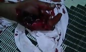 Severe Deep Wounded Hand