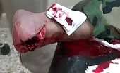 Severely Injured With Ghastly Wound In The Foot