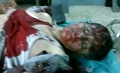 Brutally Injured In Bombing – 1